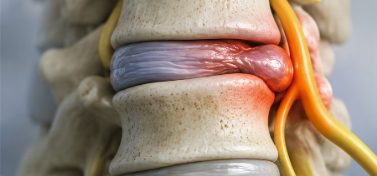 Herniated disc bulging and pressing on the nerve